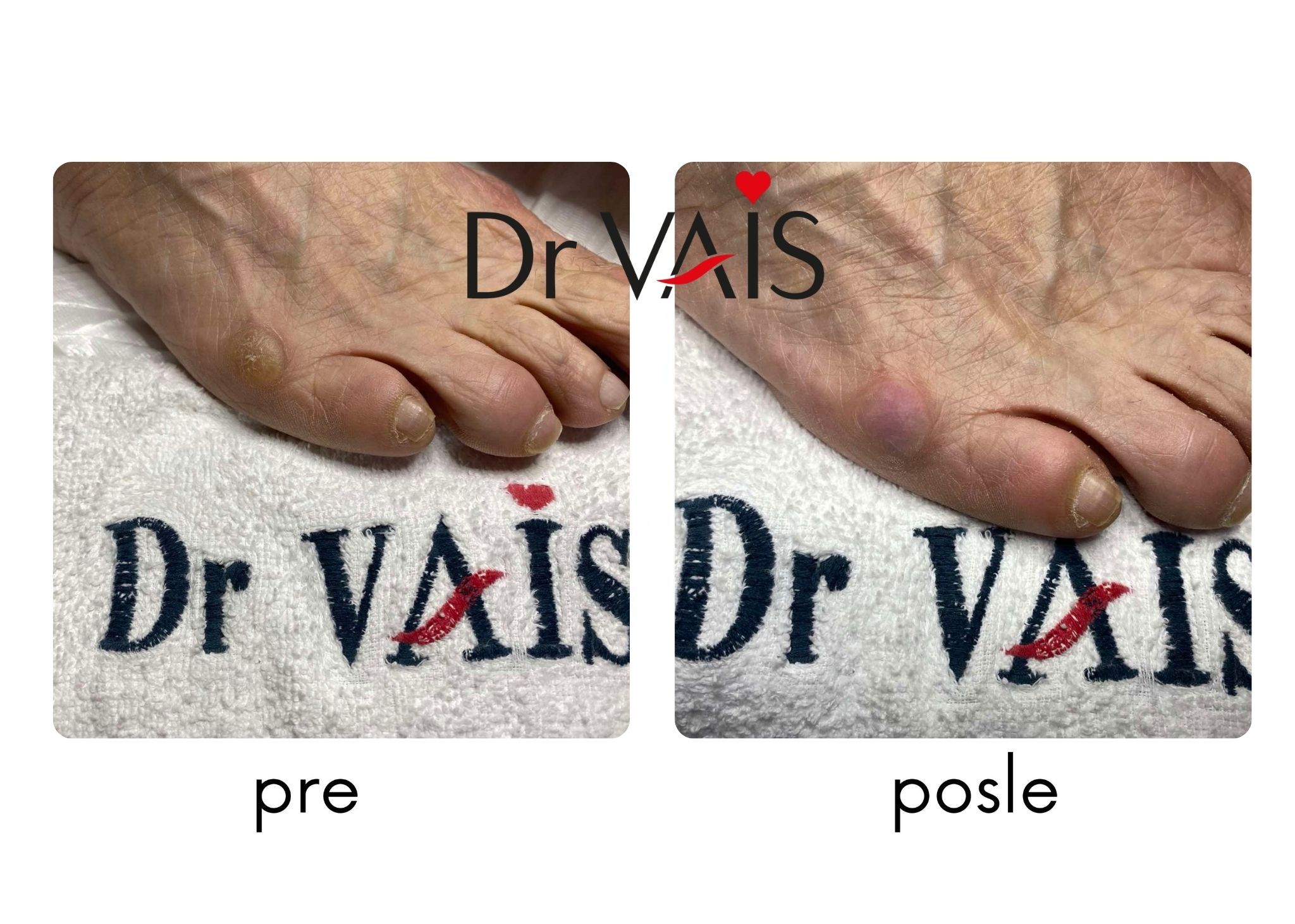 Kurje oči - lečenje